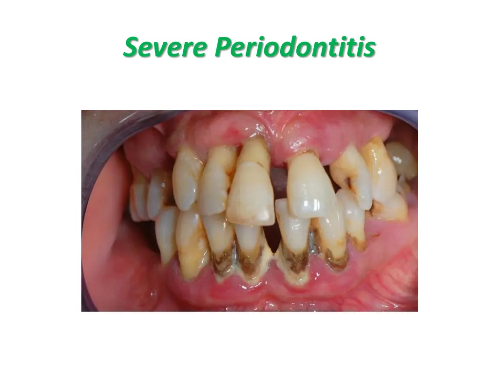 severe periodontitis