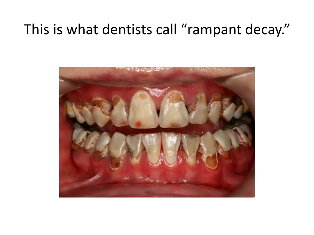 this is what dentists call rampant decay