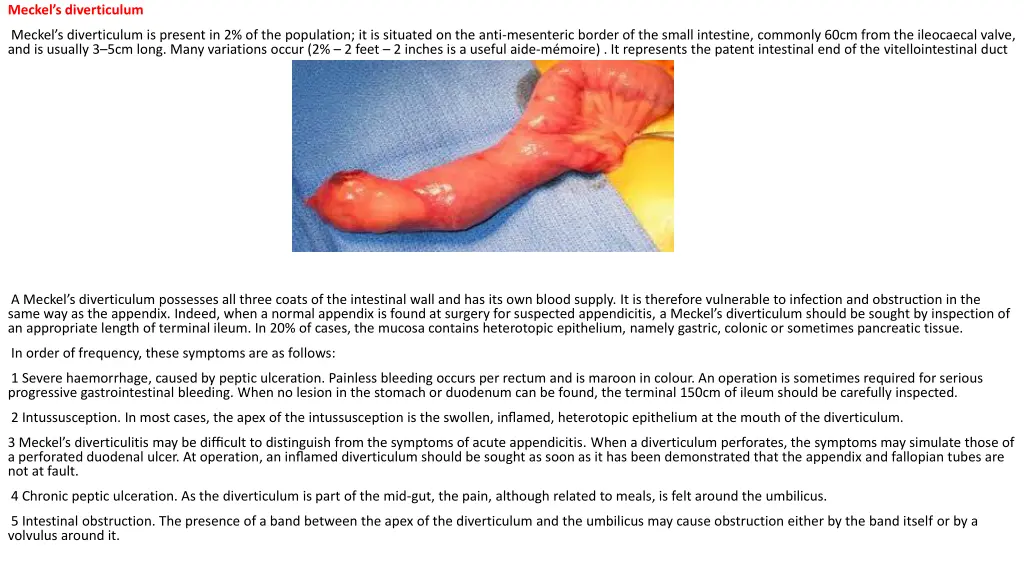 meckel s diverticulum