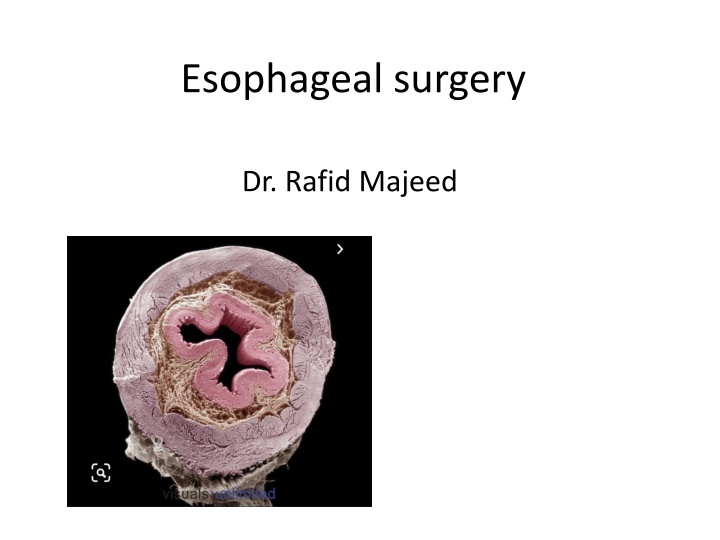 esophageal surgery
