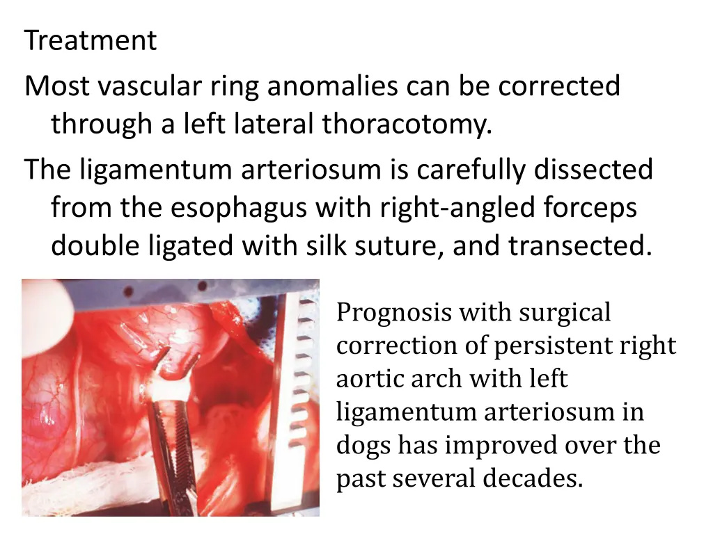 treatment most vascular ring anomalies