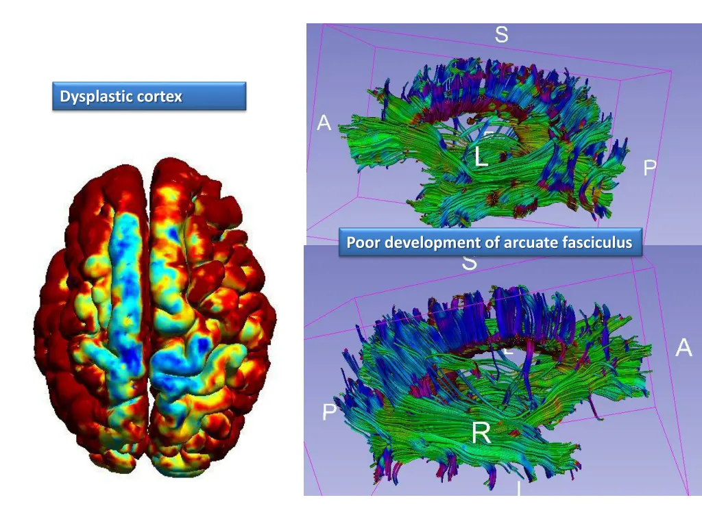 dysplastic cortex