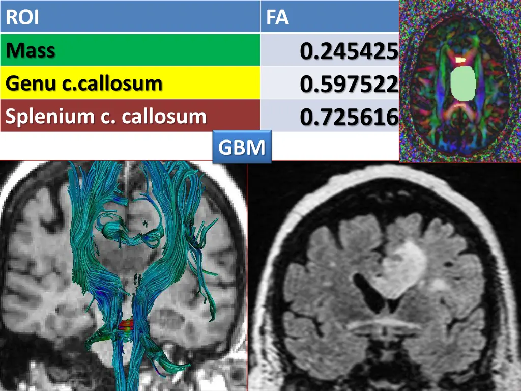 roi mass genu c callosum splenium c callosum