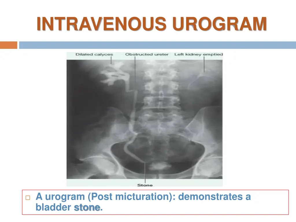 intravenous urogram
