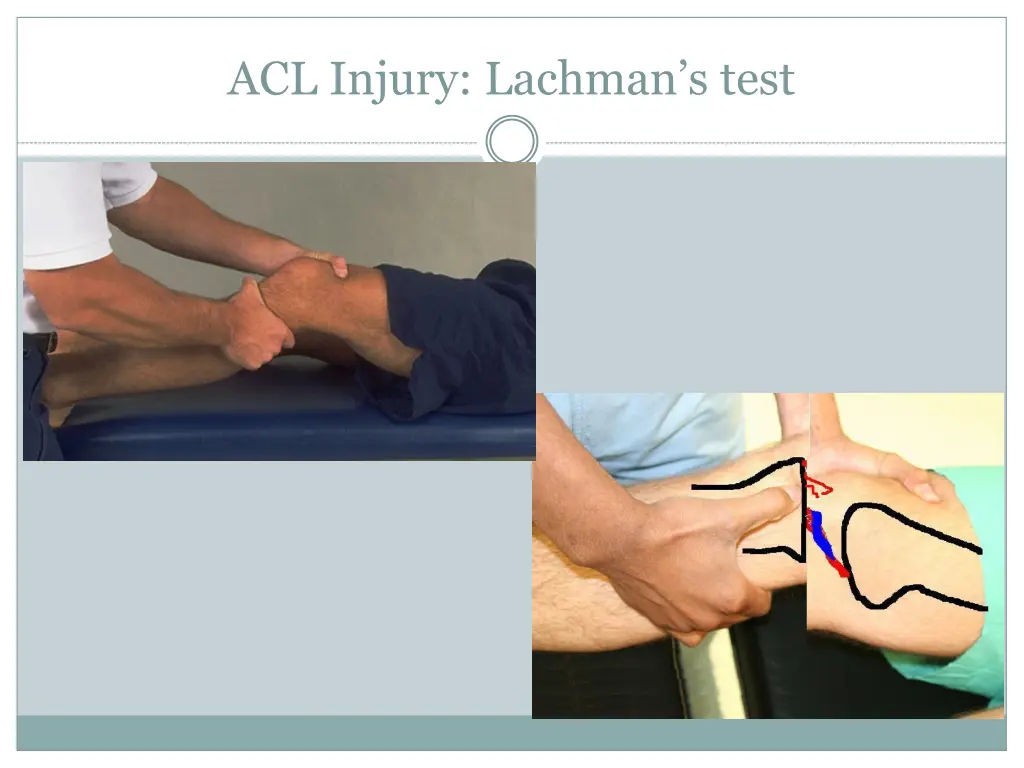 acl injury lachman s test