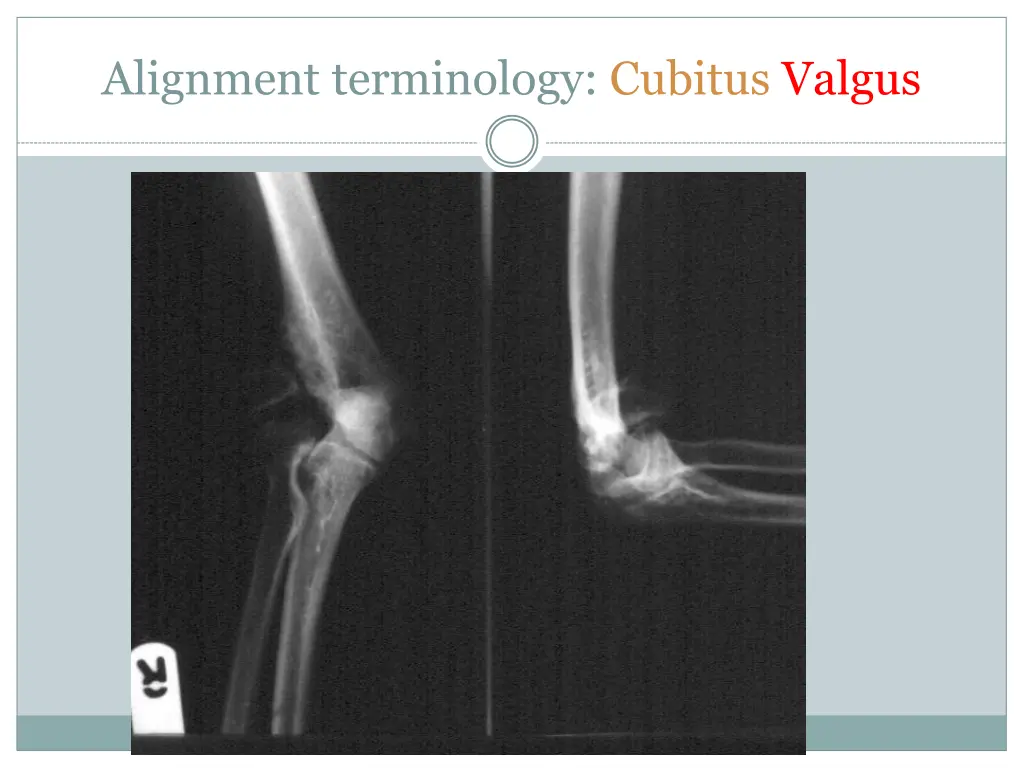 alignment terminology cubitus valgus