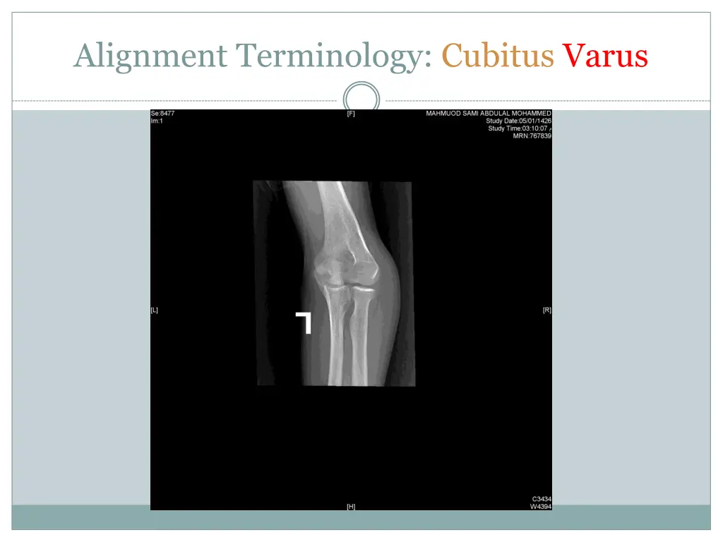 alignment terminology cubitus varus