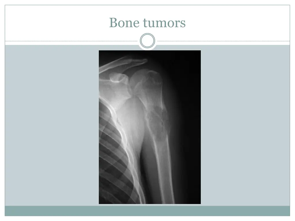 bone tumors 1