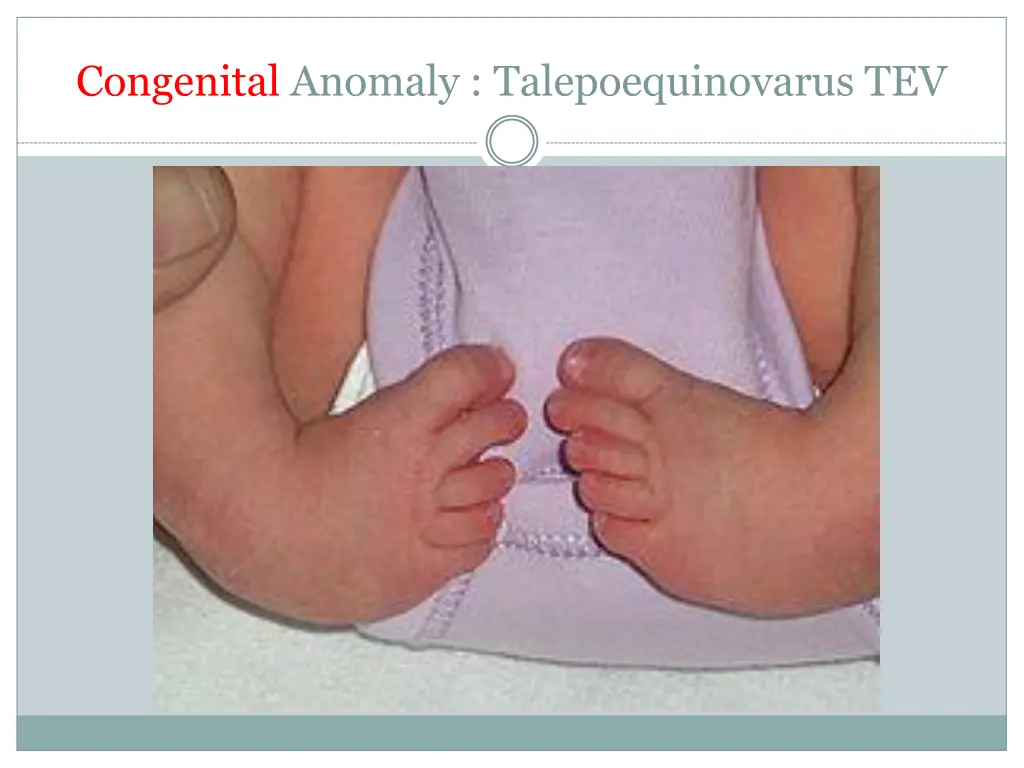 congenital anomaly talepoequinovarus tev