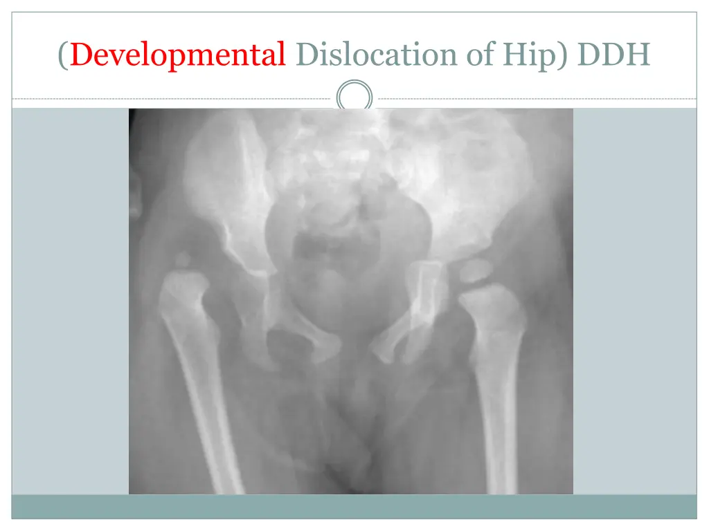 developmental dislocation of hip ddh