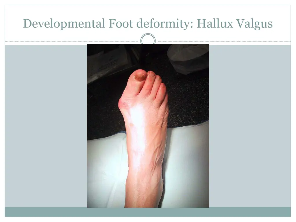developmental foot deformity hallux valgus