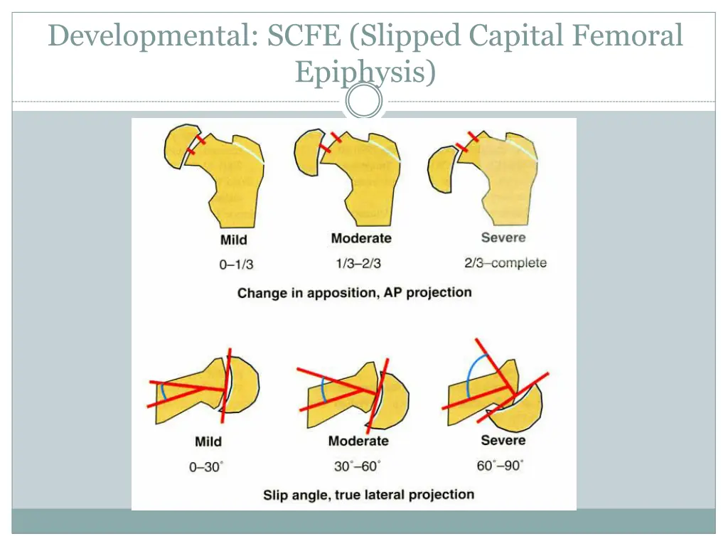 developmental scfe slipped capital femoral