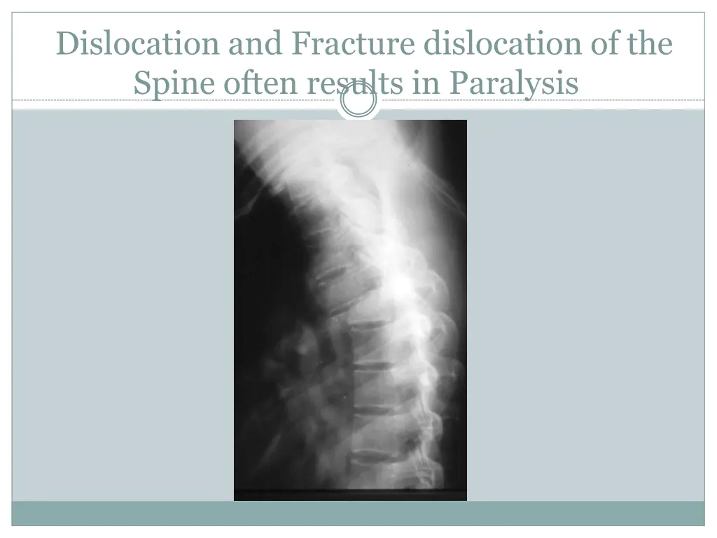 dislocation and fracture dislocation of the spine