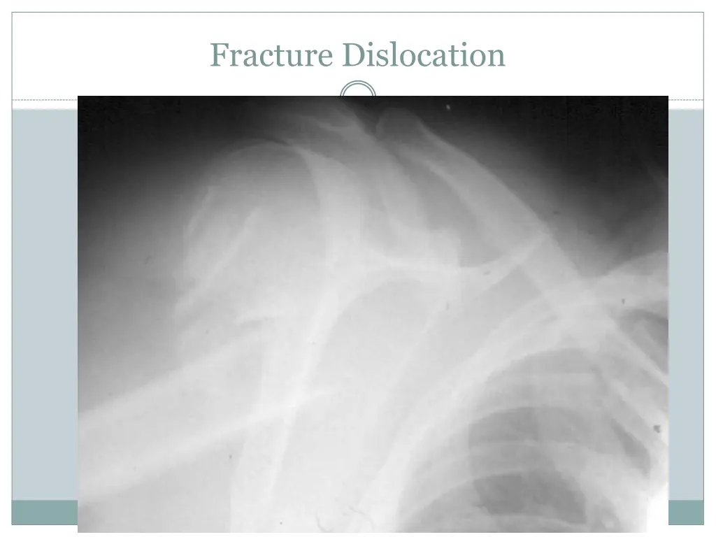 fracture dislocation