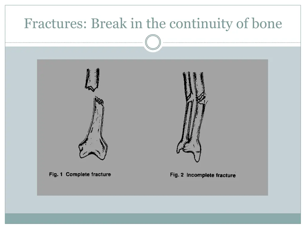 fractures break in the continuity of bone