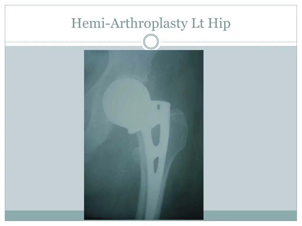 hemi arthroplasty lt hip