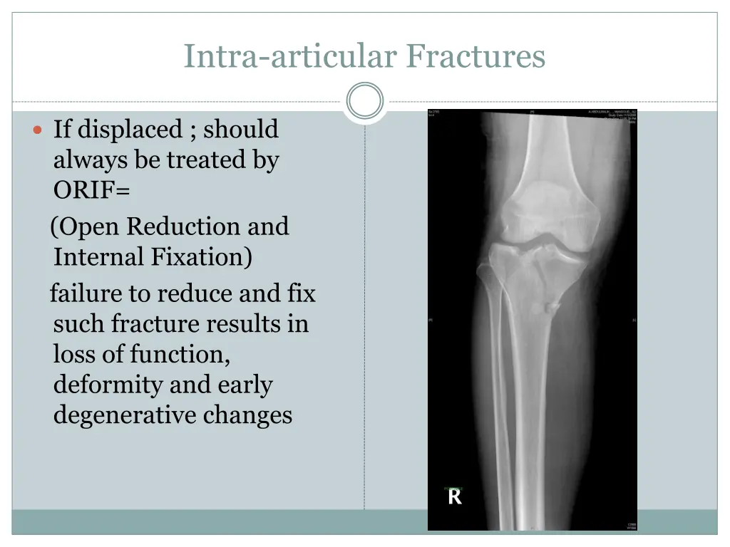 intra articular fractures