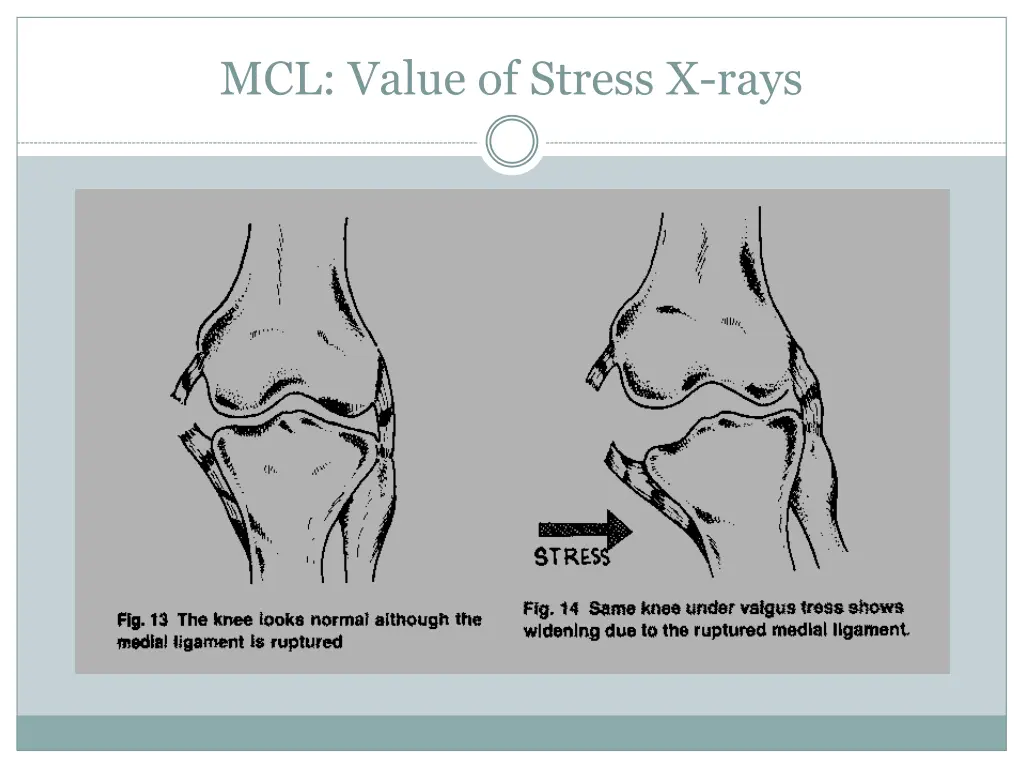 mcl value of stress x rays