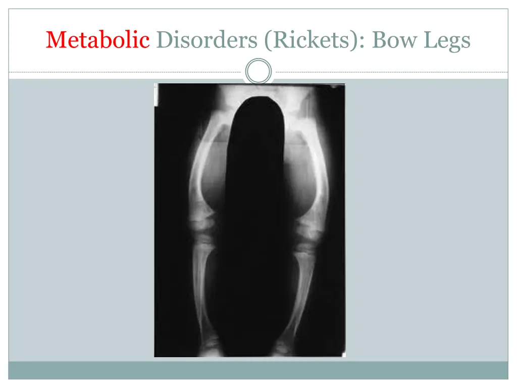 metabolic disorders rickets bow legs