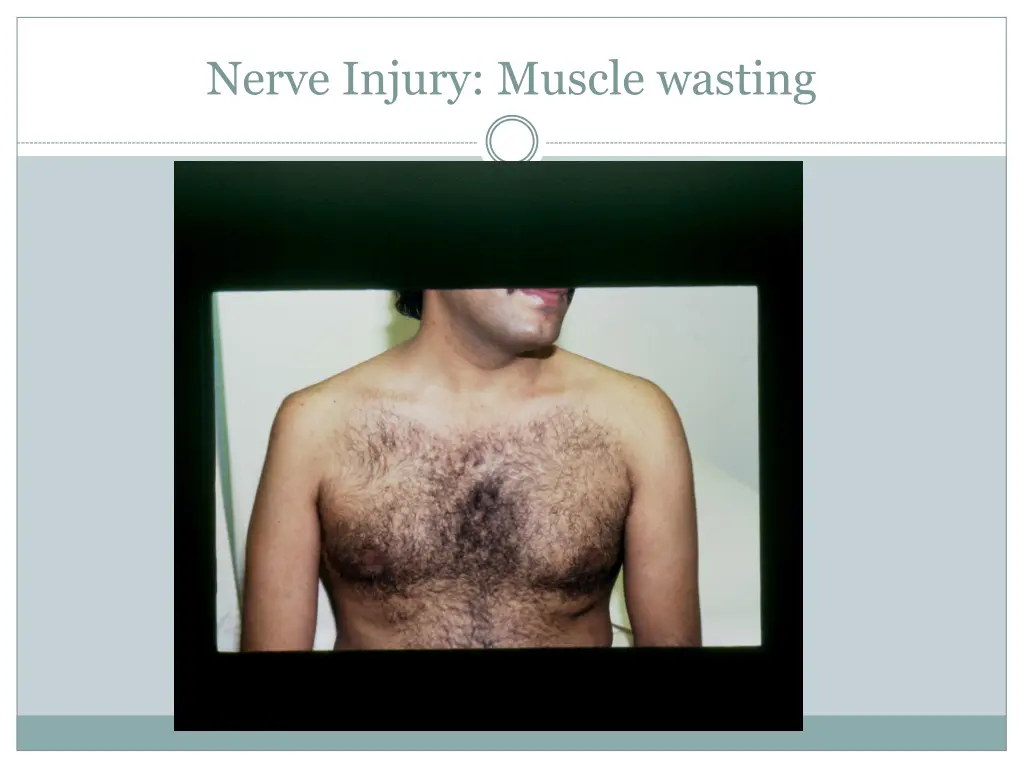 nerve injury muscle wasting