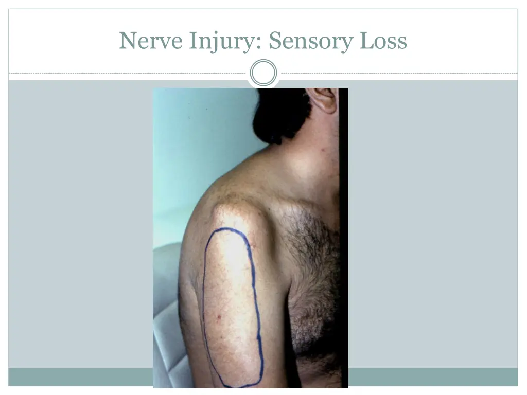 nerve injury sensory loss