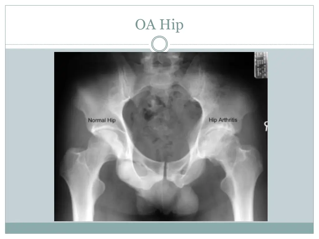 oa hip