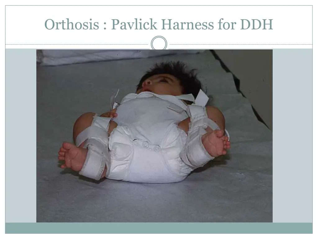 orthosis pavlick harness for ddh