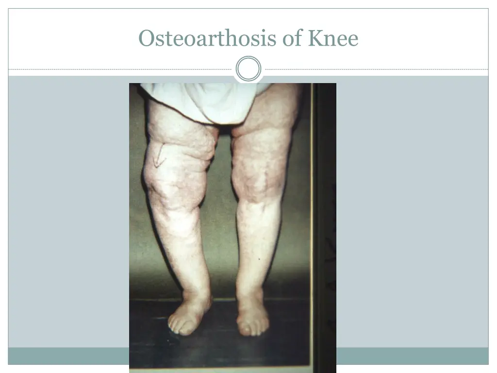 osteoarthosis of knee