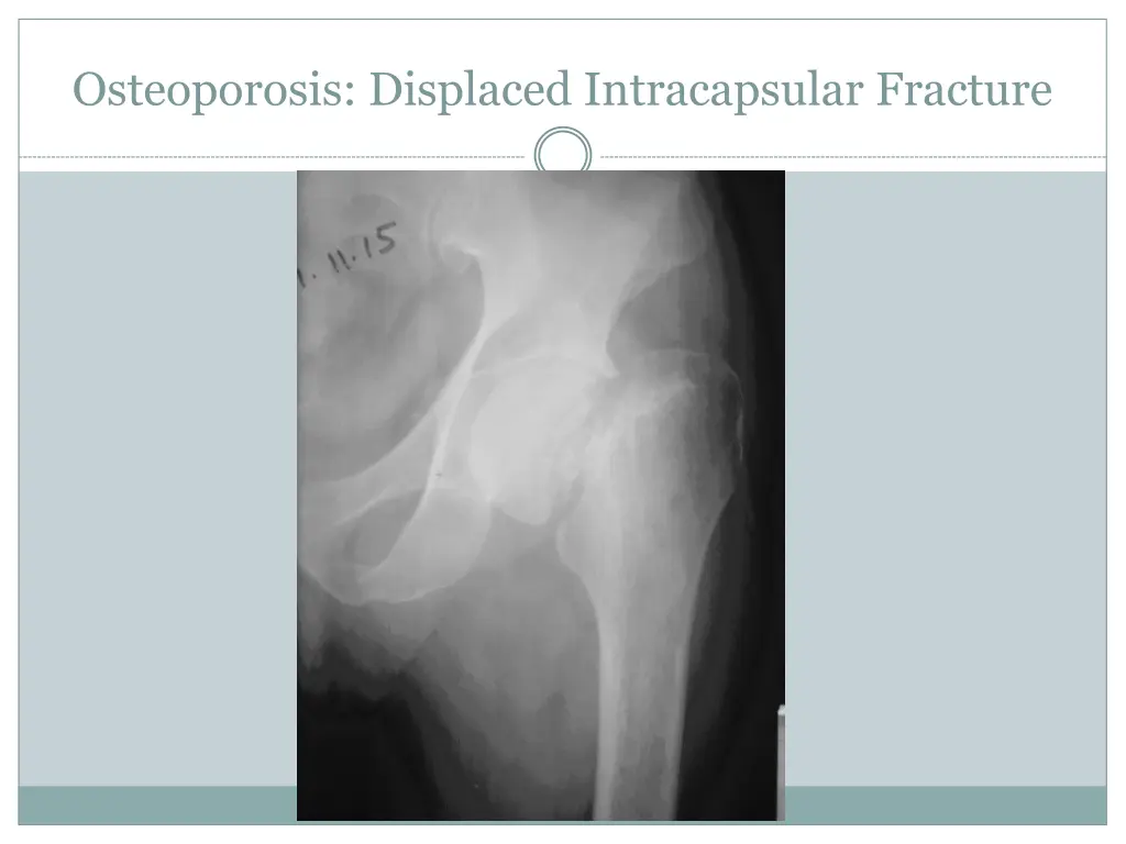 osteoporosis displaced intracapsular fracture