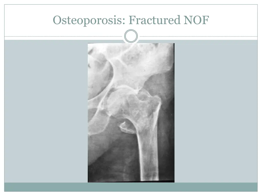 osteoporosis fractured nof