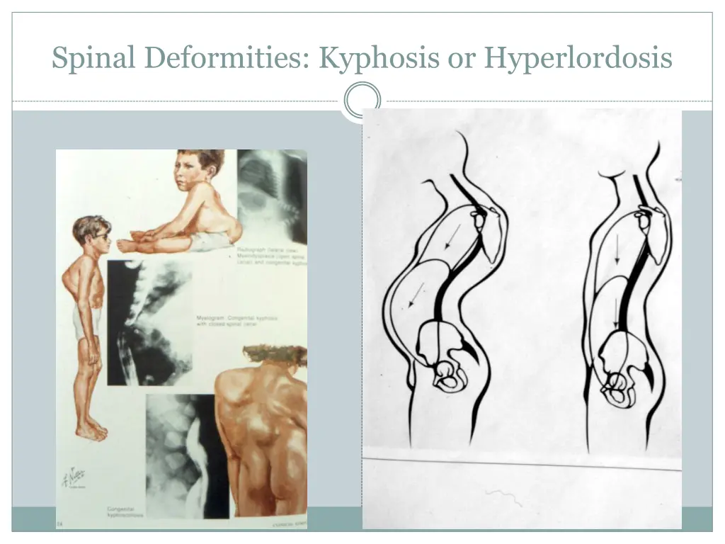 spinal deformities kyphosis or hyperlordosis