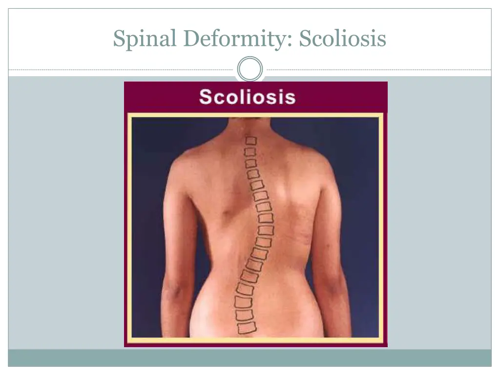 spinal deformity scoliosis