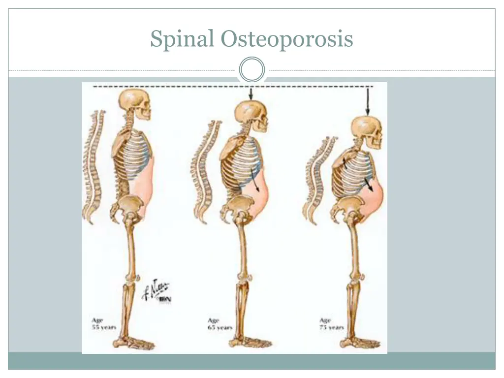 spinal osteoporosis
