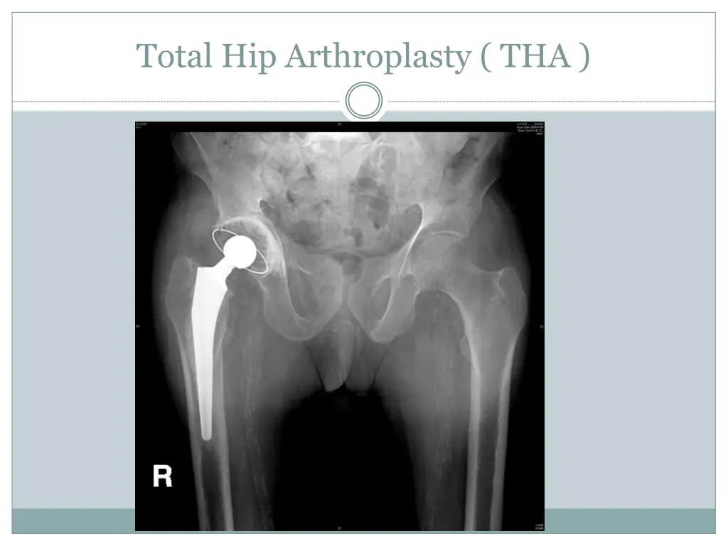 total hip arthroplasty tha