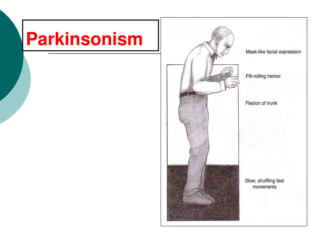 parkinsonism 1