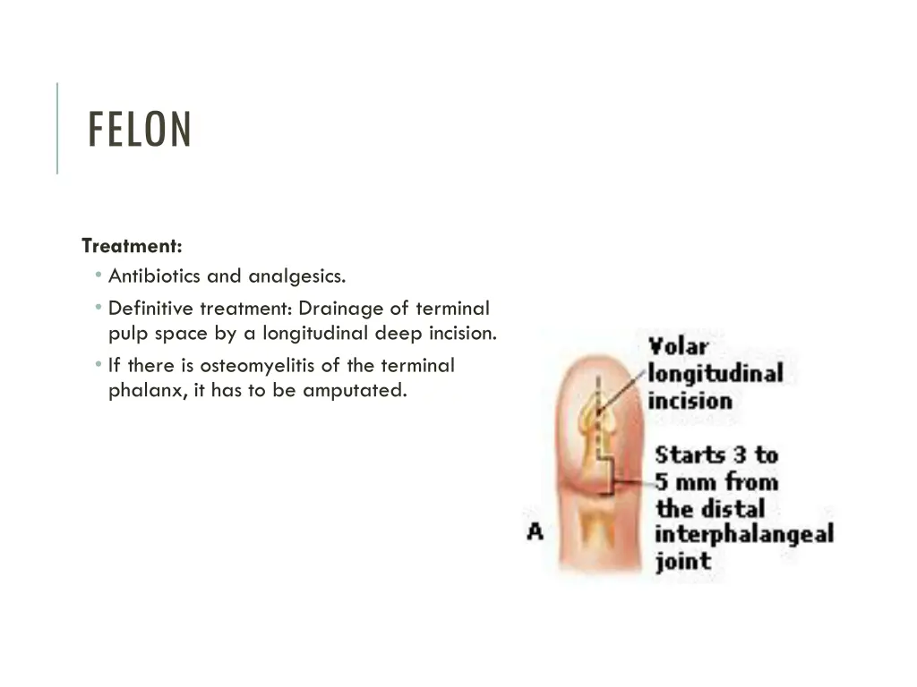 felon 5