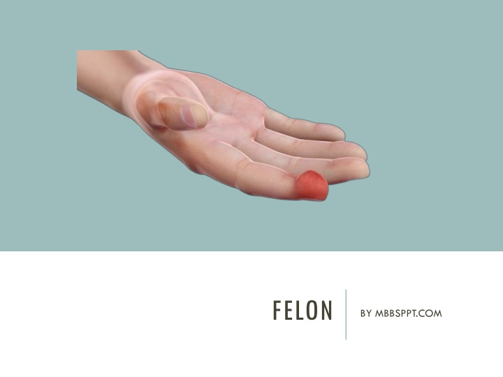 felon