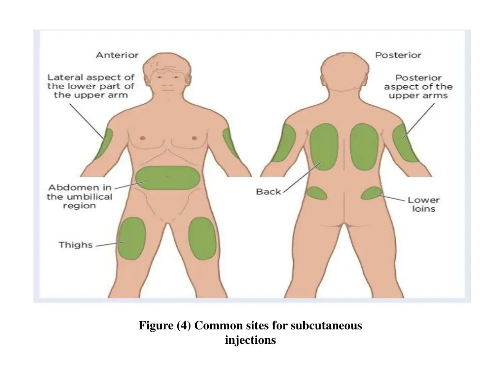 figure 4 common sites for subcutaneous injections