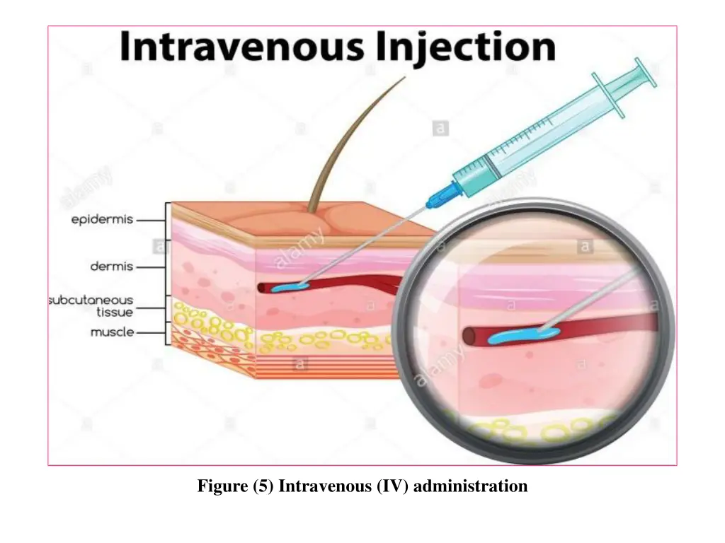 figure 5 intravenous iv administration