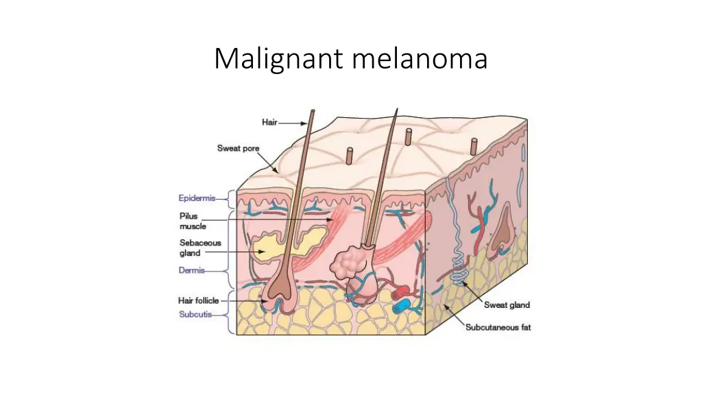 malignant melanoma