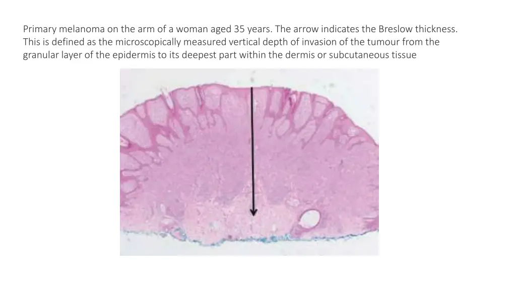 primary melanoma on the arm of a woman aged
