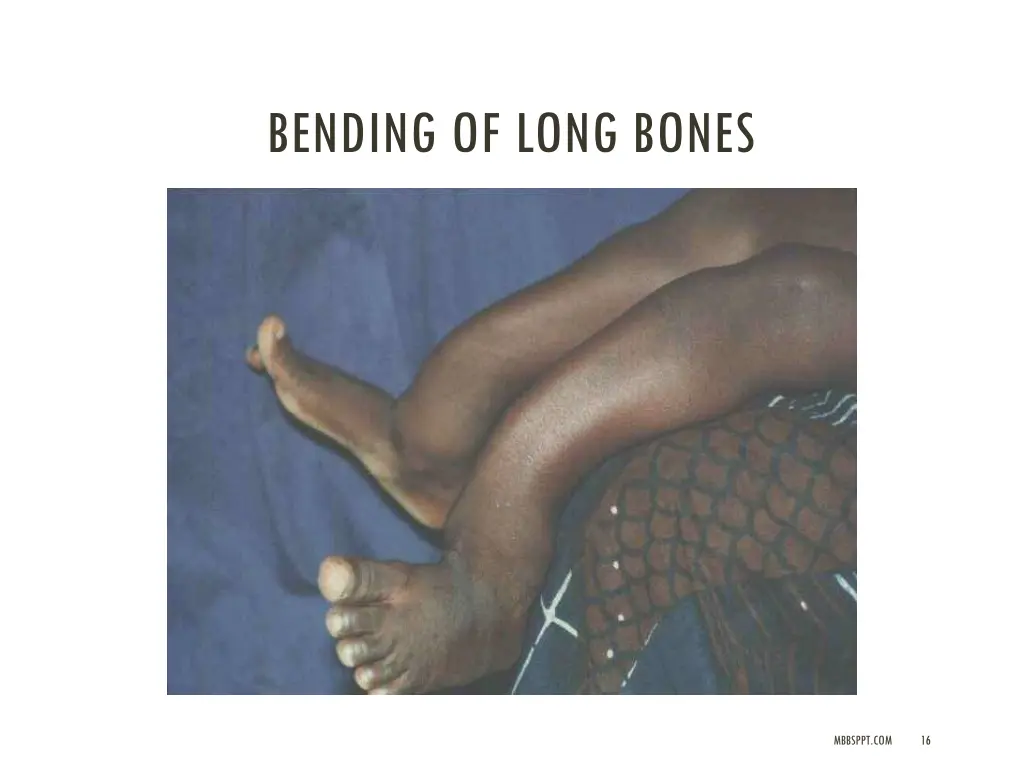 bending of long bones