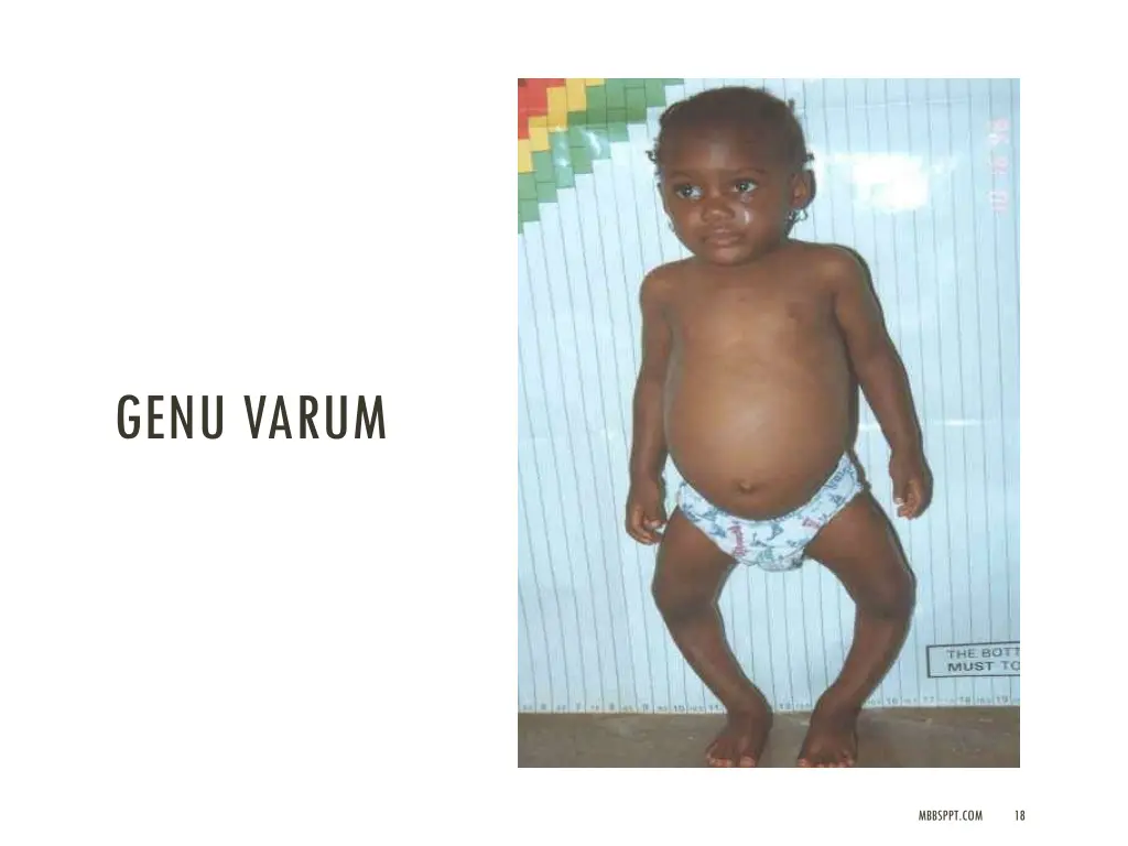 genu varum