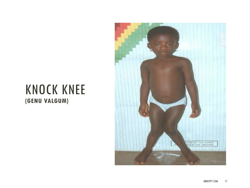 knock knee genu valgum