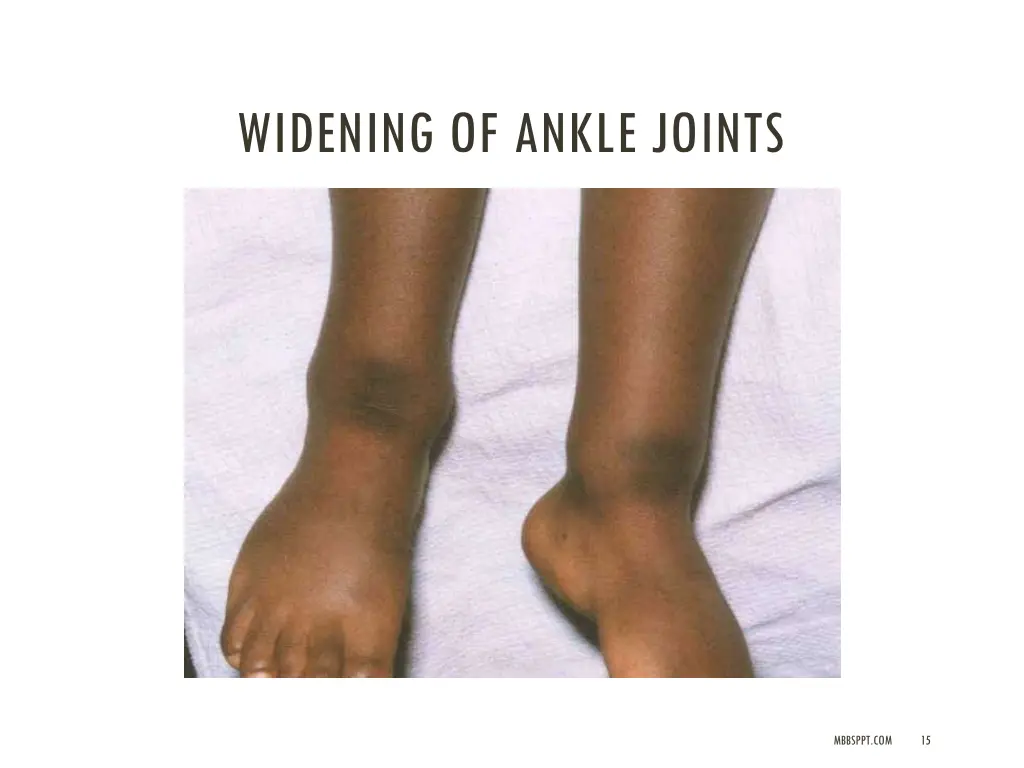 widening of ankle joints