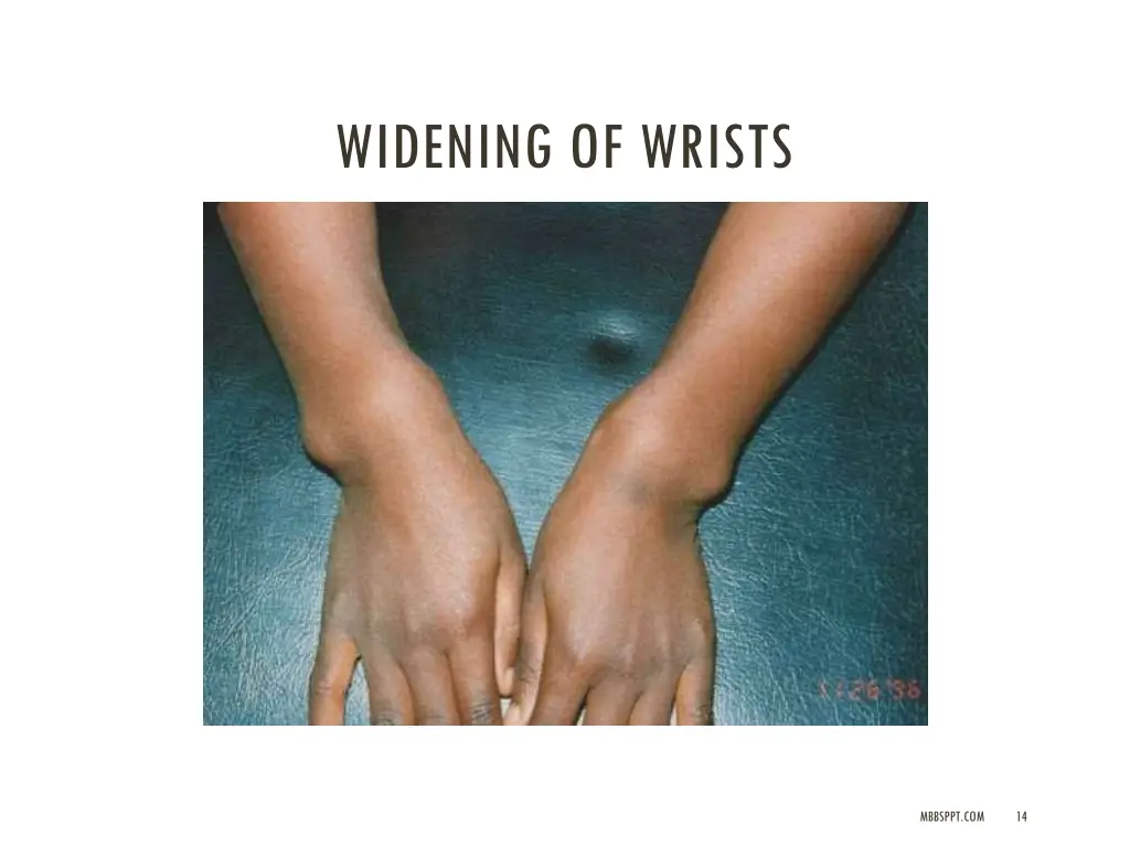 widening of wrists