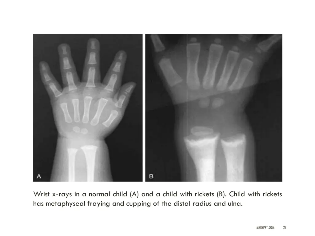 wrist x rays in a normal child a and a child with