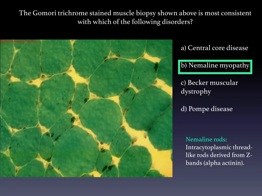 the gomori trichrome stained muscle biopsy shown