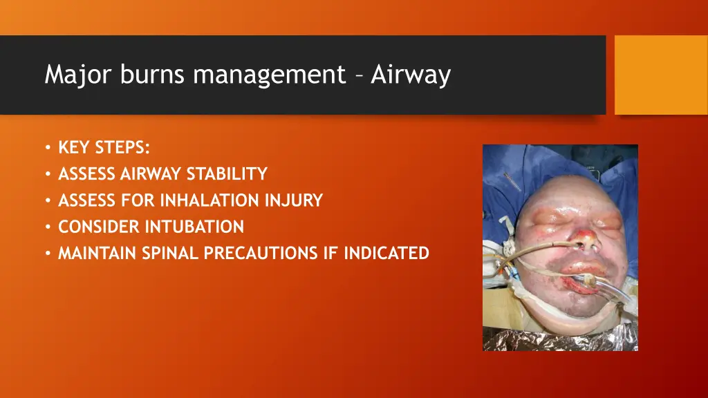 major burns management airway