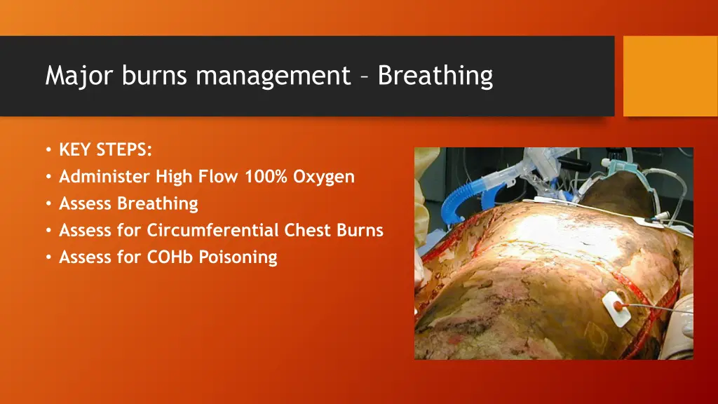 major burns management breathing